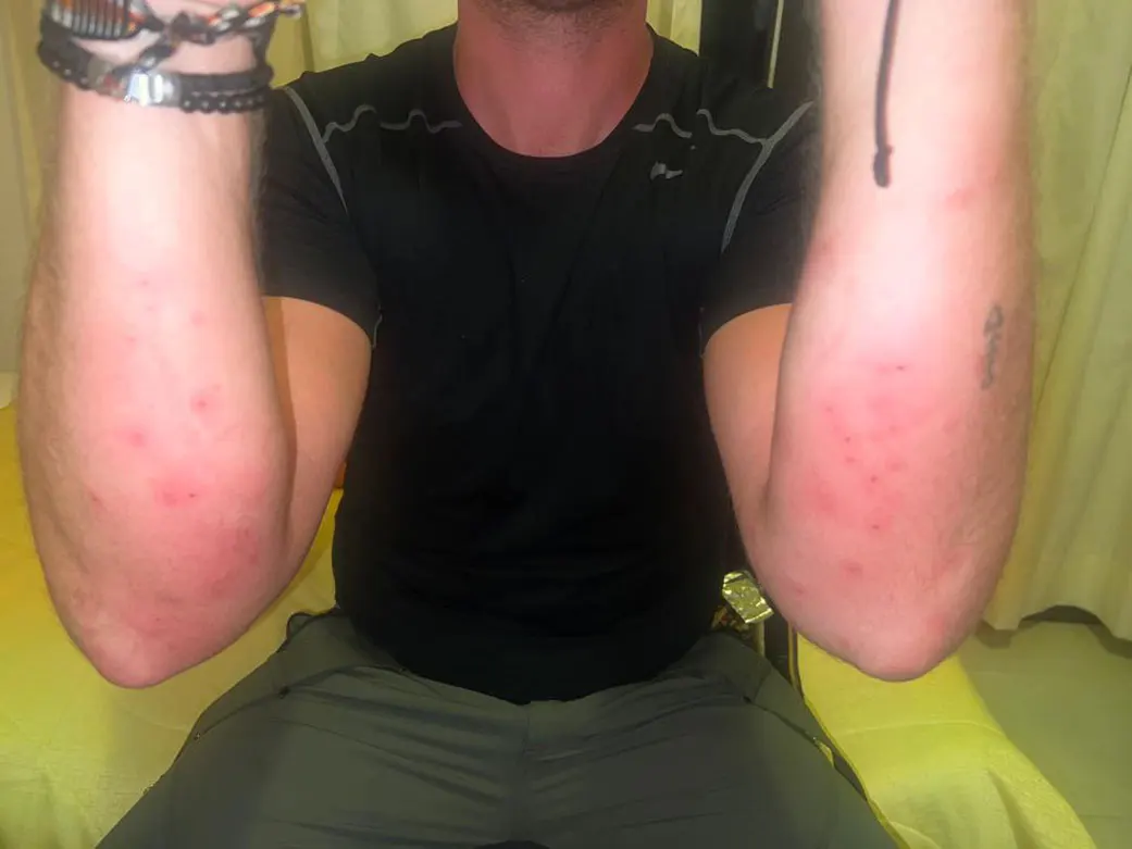 A victim of sand flies